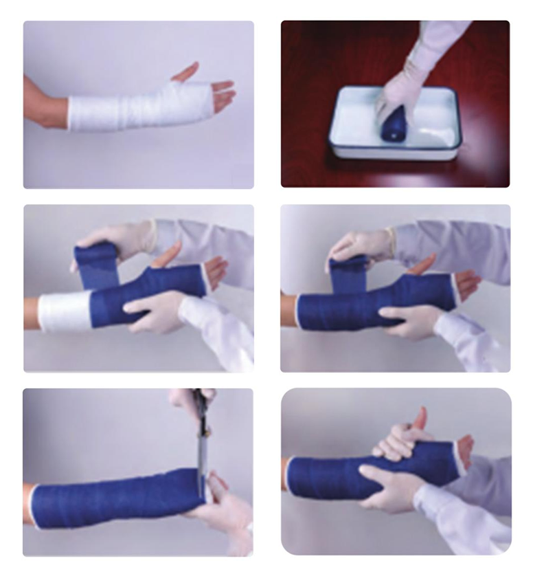 Schritte zur Verwendung des orthopädischen Gipsbandes